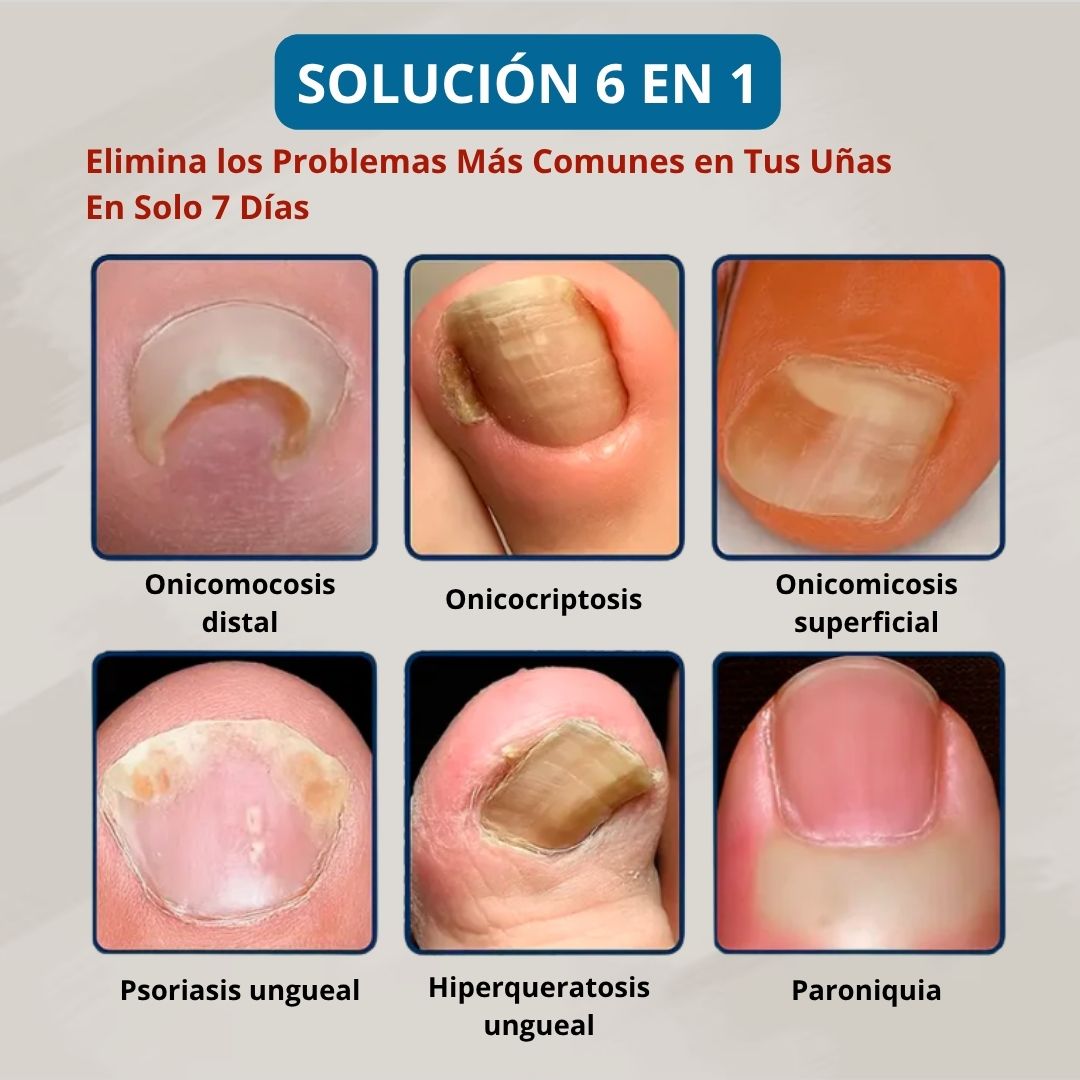 ToenilPlus™ Aceite Antihongos x2 Unidades